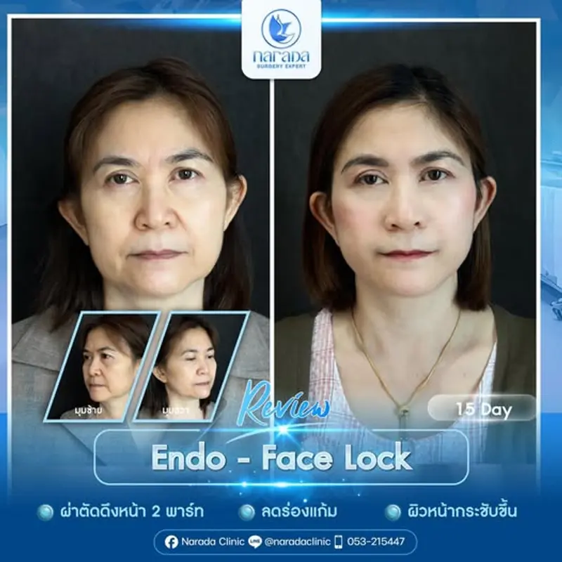 รีวิว 15 วัน✨ ย้อนวัยธรรมชาติ ด้วย Endo - Face Lock ที่ นารดาคลินิก
