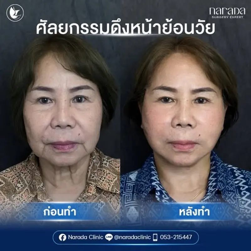 ย้อนวัย สวยเป๊ะทุกมุมมอง ด้วย Endo - Face Lock ✨ที่ นารดาคลินิก