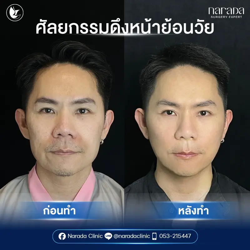 รีวิว  Mini Face Lock ที่ นารดาคลินิก