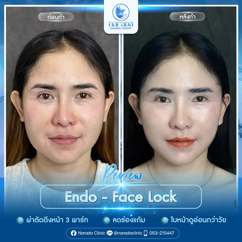รีวิว Endo Face Lock ล็อคหน้าให้เป๊ะ ตึงกระชับทุกองศา