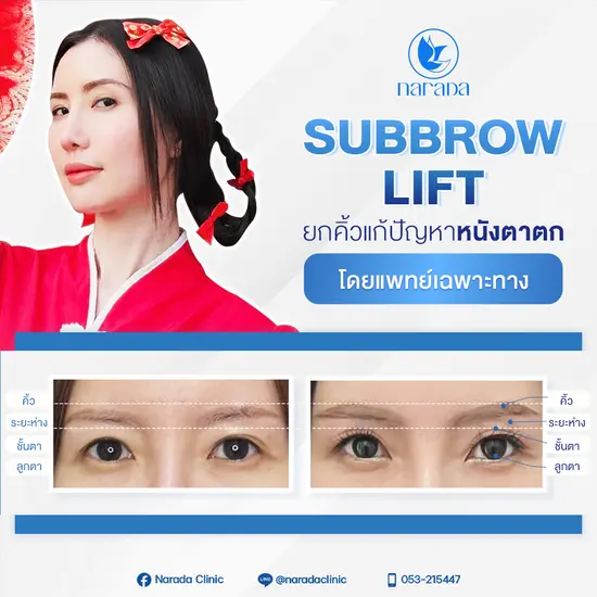 การผ่าตัดยกคิ้ว SubBrowLift การผ่าตัดยกคิ้ว SubBrowLift