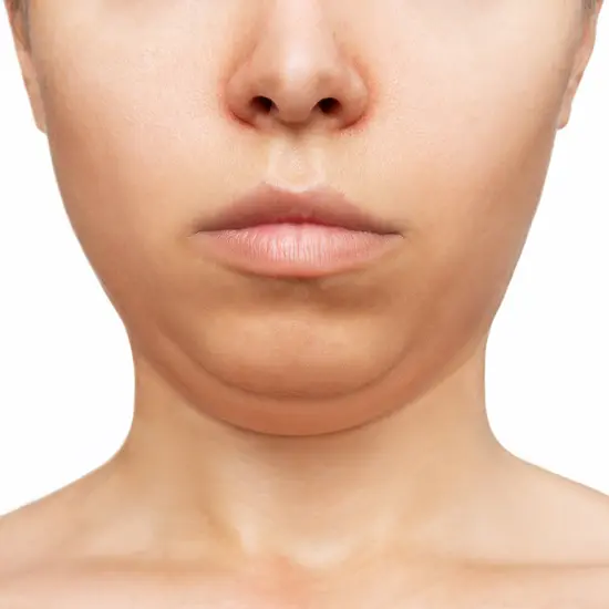 เติมร่องแก้ม