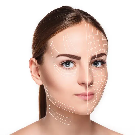 ร้อยไหม (Thread Lift)  ร้อยไหม (Thread Lift)