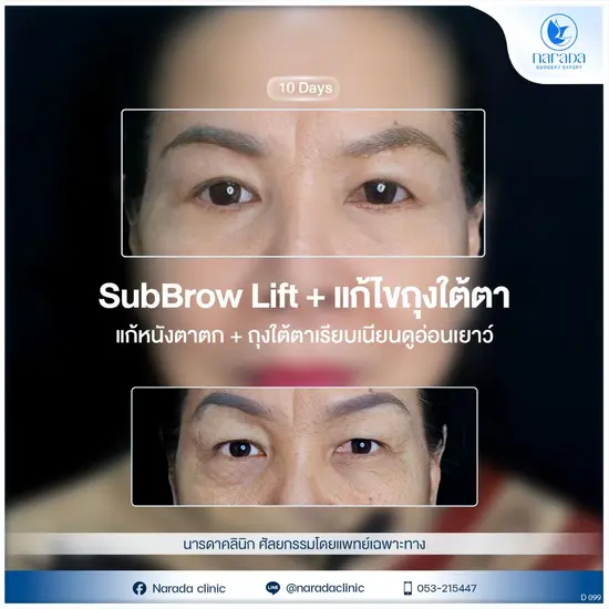 Subbrow Lift ยกหางตาและกระชับเปลือกตาบนโดยหมอเฉพาะทาง