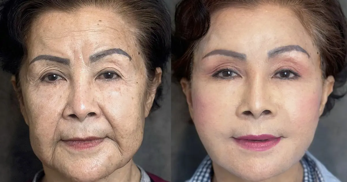 ดึงหน้าแบบไหนดี? รวมเทคนิคยอดนิยมจากศัลยแพทย์เฉพาะทางนารดาคลินิก