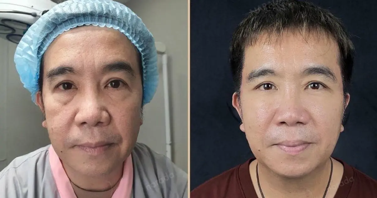 รวมโปรแกรมศัลยกรรมยกกระชับหน้าในเชียงใหม่ ที่นารดาคลินิก