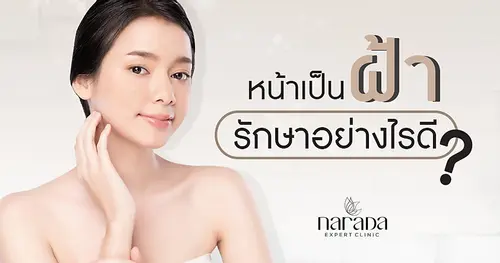 หน้าเป็นฝ้ารักษาอย่างไรดี? นารดาคลินิกให้บริการรักษาฝ้าทุกชนิดแบบบูรณาการ
