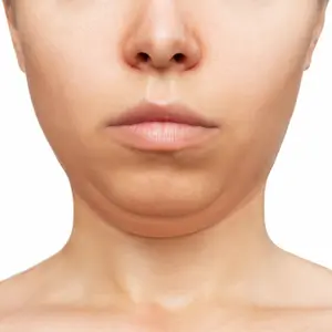 เติมร่องแก้ม