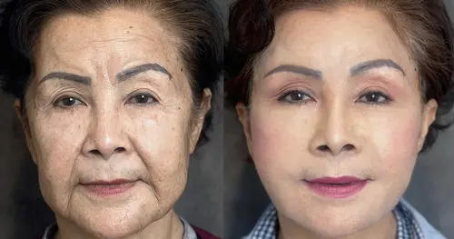 ดึงหน้าแบบไหนดี? รวมเทคนิคยอดนิยมจากศัลยแพทย์เฉพาะทางนารดาคลินิก