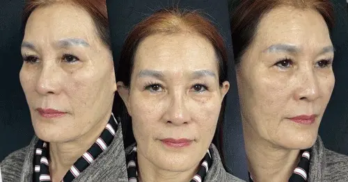 รีวิวภาพก่อน-หลัง ดึงหน้าจริงจากเคสคนไข้นารดาคลินิก