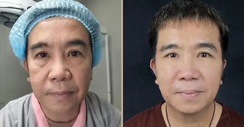 รวมโปรแกรมศัลยกรรมยกกระชับหน้าในเชียงใหม่ ที่นารดาคลินิก