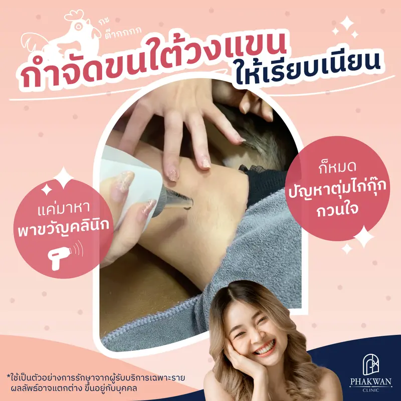 กำจัดขนใต้วงแขน