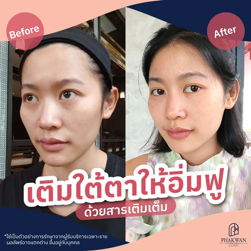 สารเติมเต็มใต้ดวงตา