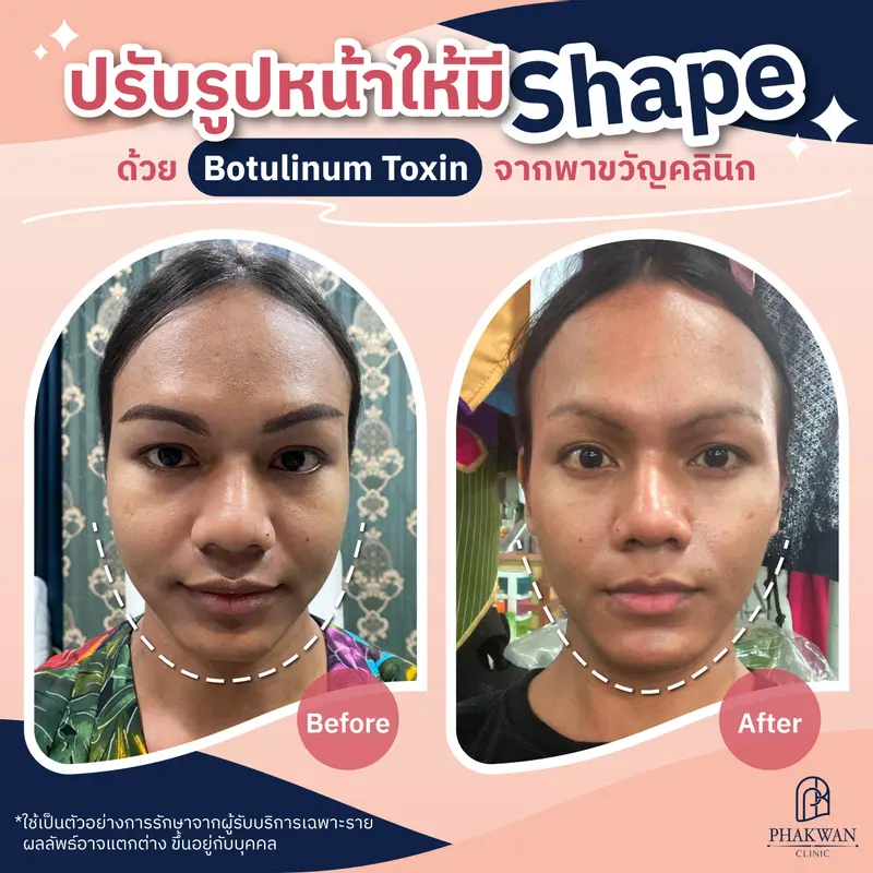 ปรับรูปหน้า