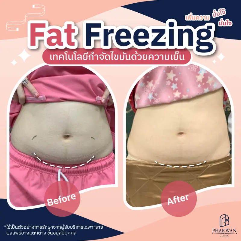 Fat freezing