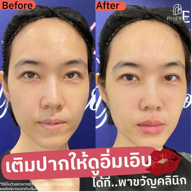 สารเติมเต็มปาก