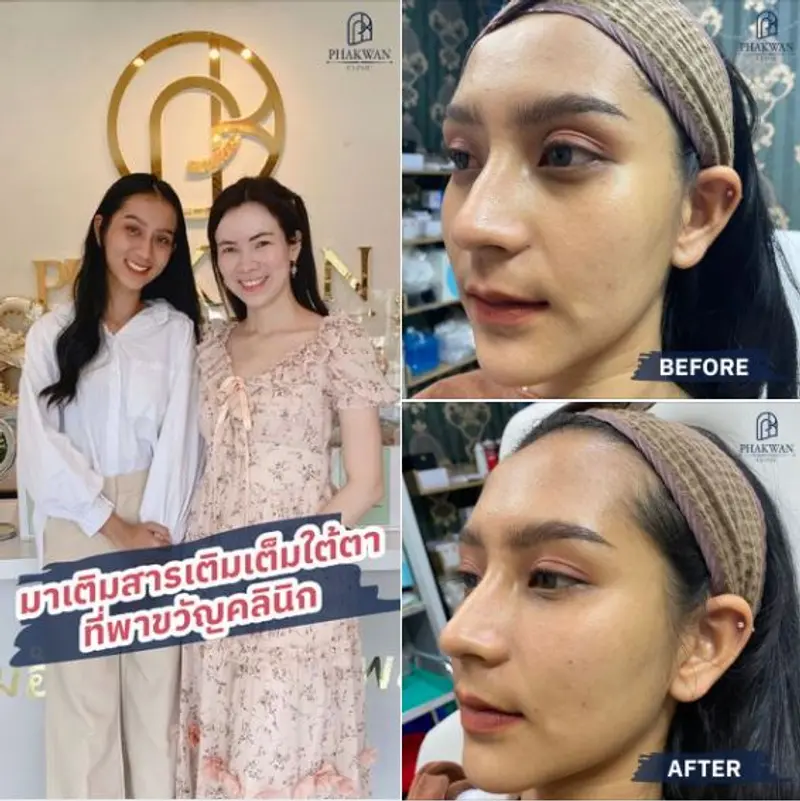 สารเติมเต็มใต้ตา