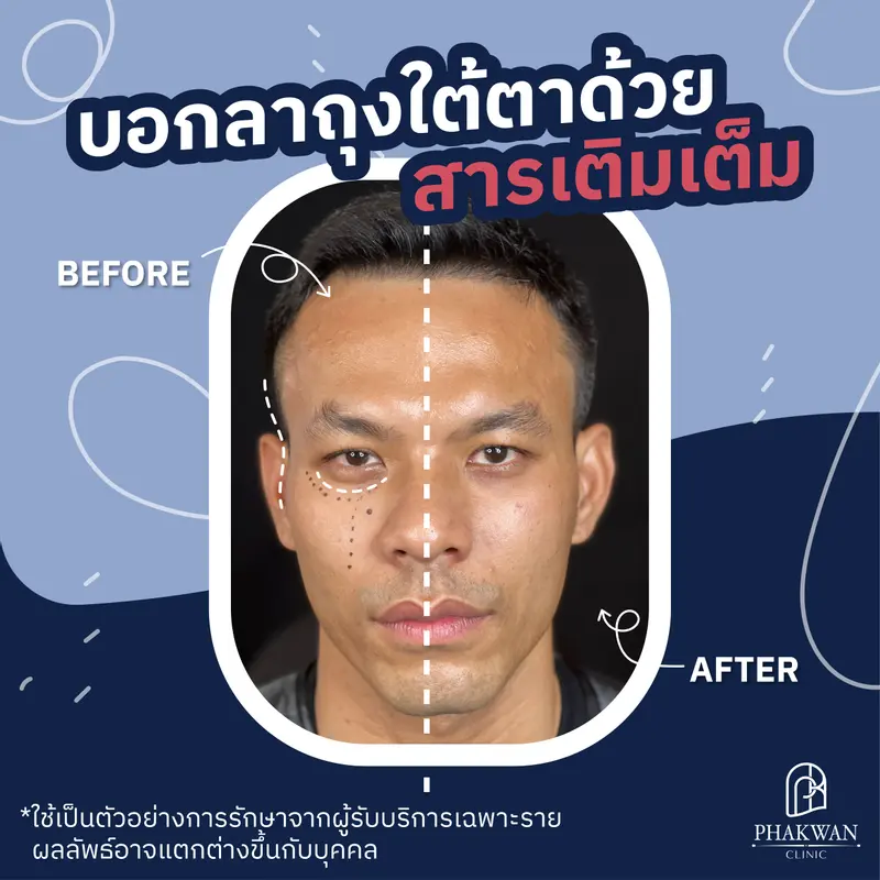 สารเติมเต็มใต้ตา