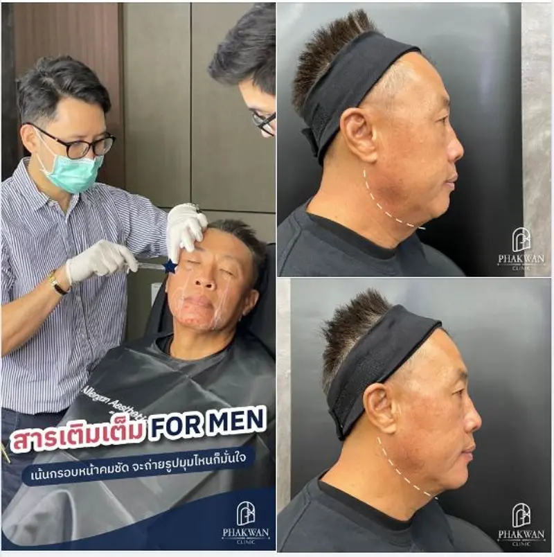 สารเติมเต็มบริเวณสันกรามคุณผู้ชาย