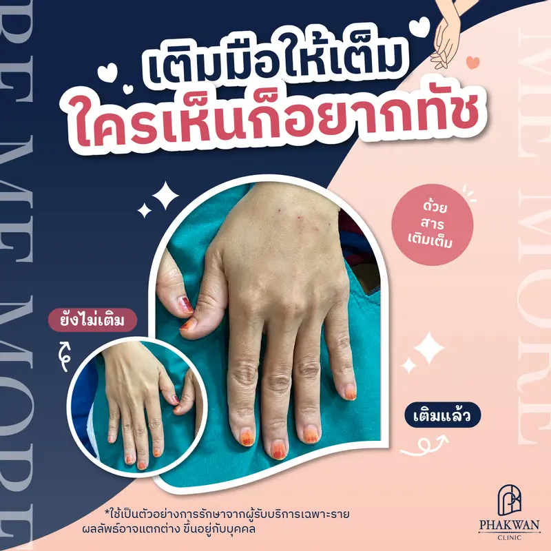 ฉีดสารเติมเต็ม