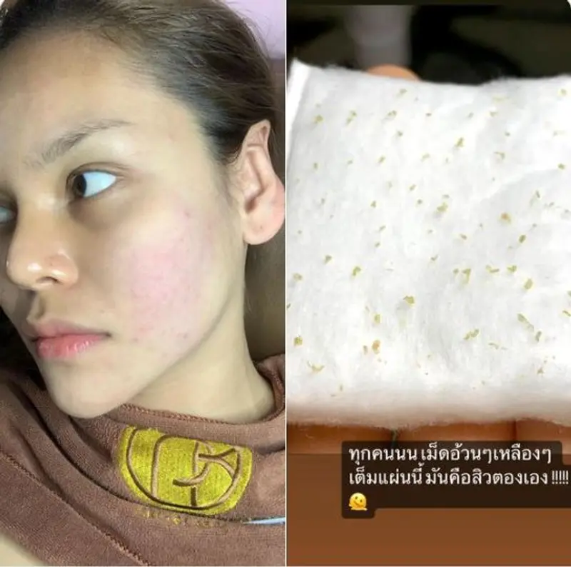 บริการกดสิว รักษาสิว พาขวัญคลินิกหาดใหญ่ 