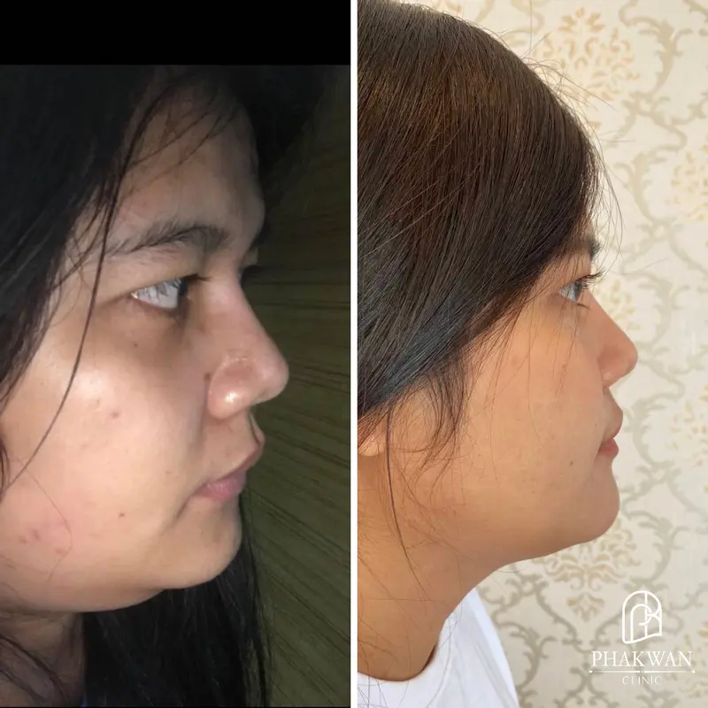 แฟตสลายไขมัน Lipotherapy