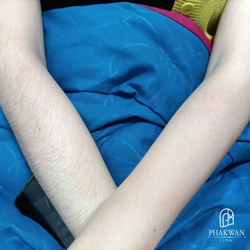 เลเซอร์ขนแขน เลเซอร์กำจัดขน พาขวัญคลินิกหาดใหญ่