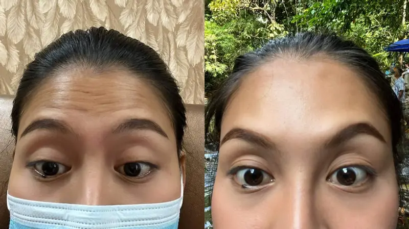 โบทูลินัมท็อกซิน ลดริ้วรอย