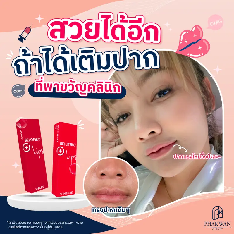 ฉีดสารเติมเต็มบริเวณริมฝีปาก ด้วย belotero lips