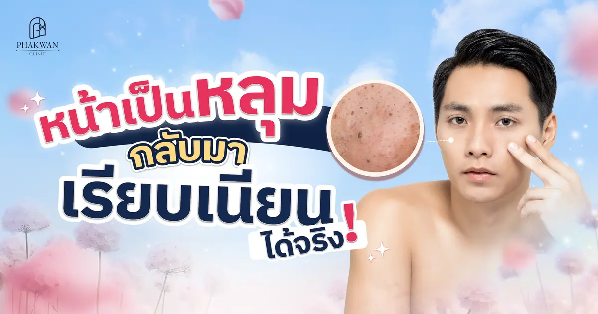 ผิวไม่เรียบเพราะหลุมสิว แก้ไขยังไงให้ผิวกลับมาเนียนได้อีกครั้ง?