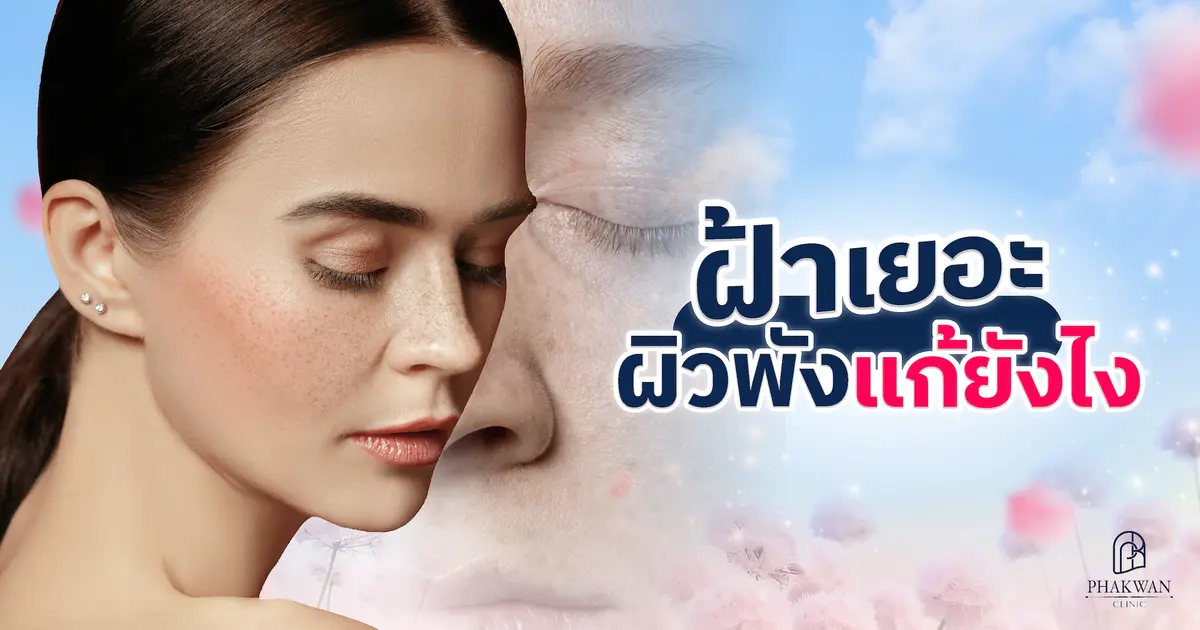 ฝ้า ฝังลึก! แก้ยาก ตัวการทำหน้าหมอง รักษายังไง? หายได้จริงไหม?