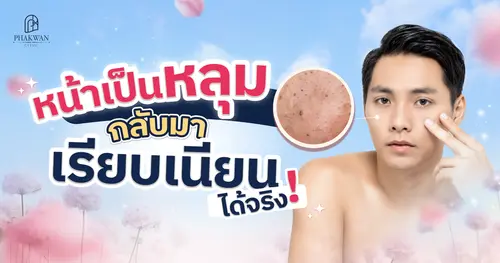ผิวไม่เรียบเพราะหลุมสิว แก้ไขยังไงให้ผิวกลับมาเนียนได้อีกครั้ง?