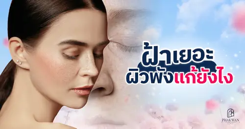 ฝ้า ฝังลึก! แก้ยาก ตัวการทำหน้าหมอง รักษายังไง? หายได้จริงไหม?