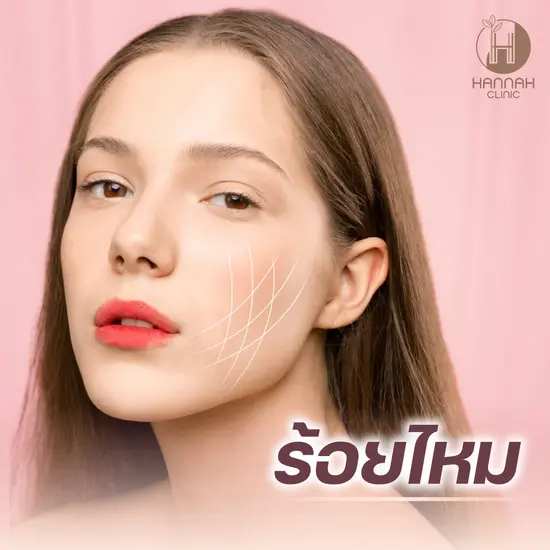 ร้อยไหม ยกกระชับ