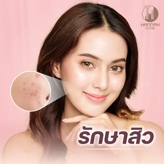 Goodbye Acne และ Miami Peel ขจัดสิว