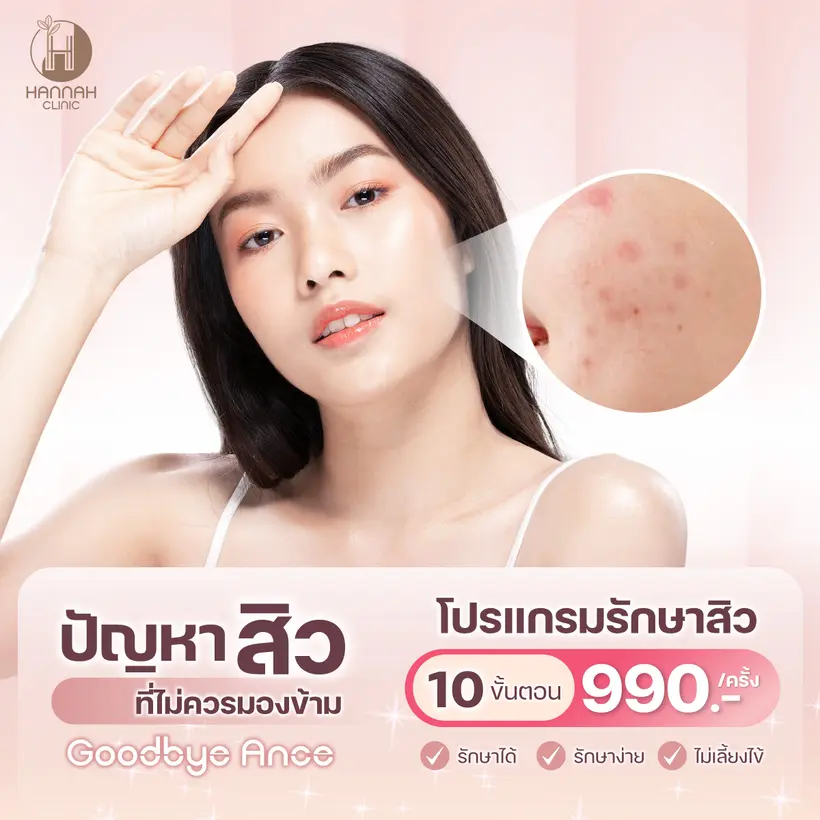 โปรแกรมรักษาสิว 10 ขั้นตอน บอกลาปัญหาสิว รักษาได้ รักษาง่าย ไม่เลี้ยงไข้