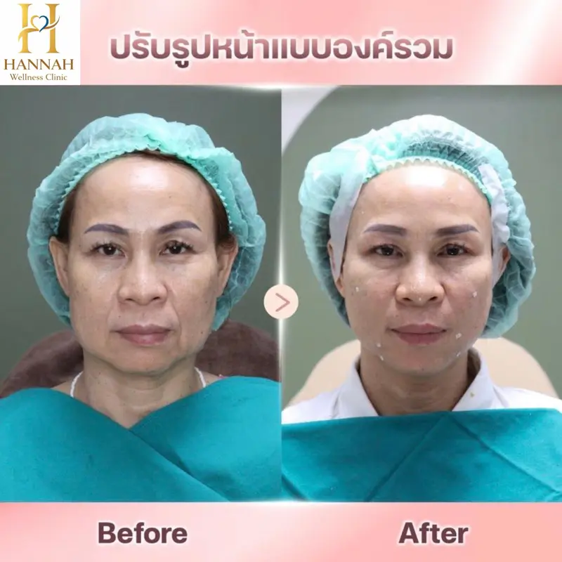 ปรับรูปหน้าแบบองค์รวม