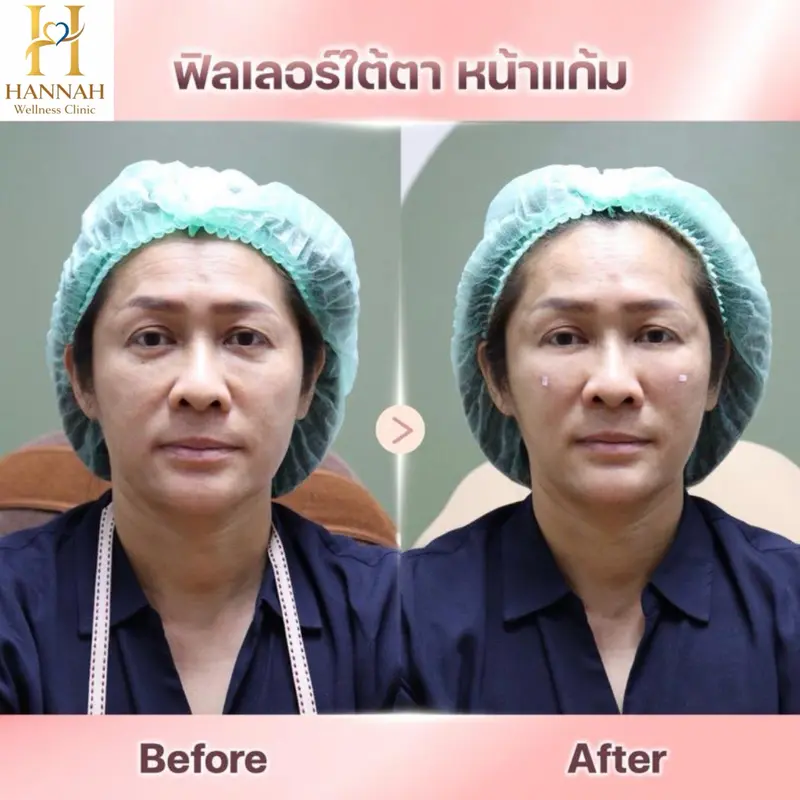 ฟิลเลอร์ ใต้ตา หน้าแก้ม