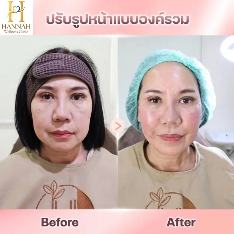 ร้อยไหมยกกระชับ