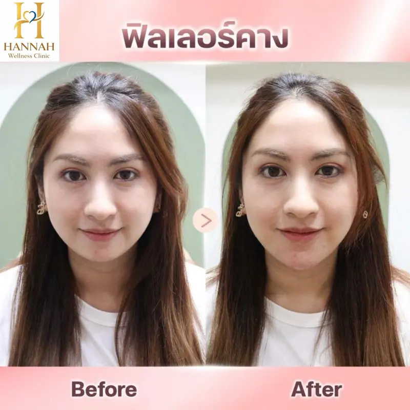 ฟิลเลอร์คาง