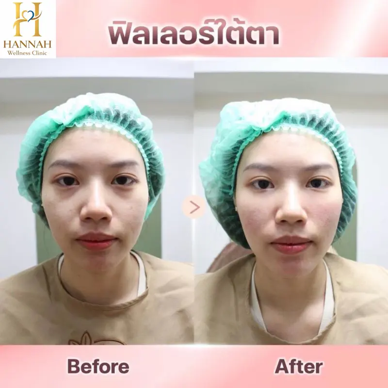 ฟิลเลอร์ ใต้ตา