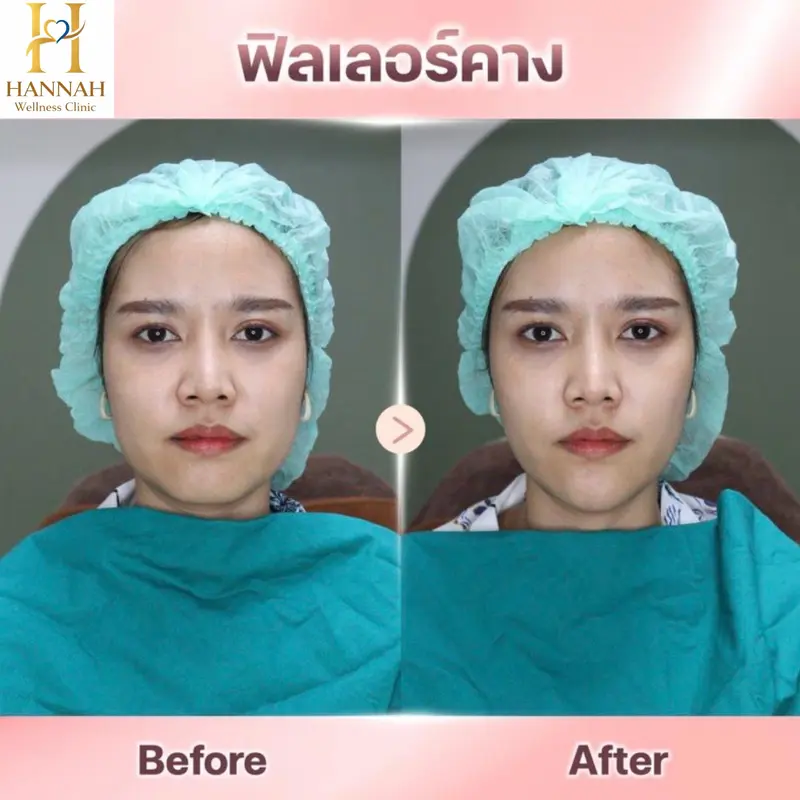 ฟิลเลอร์คาง