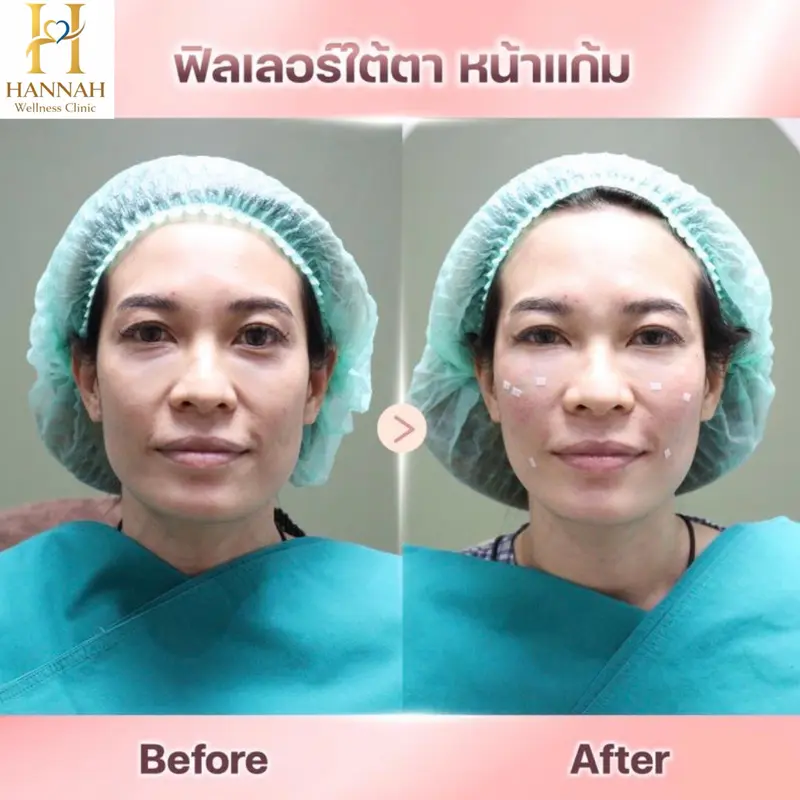 ฟิลเลอร์ ใต้ตา หน้าแก้ม