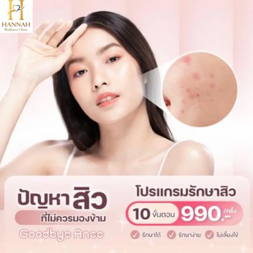 โปรแกรมรักษาสิว 10 ขั้นตอน บอกลาปัญหาสิว รักษาได้ รักษาง่าย ไม่เลี้ยงไข้