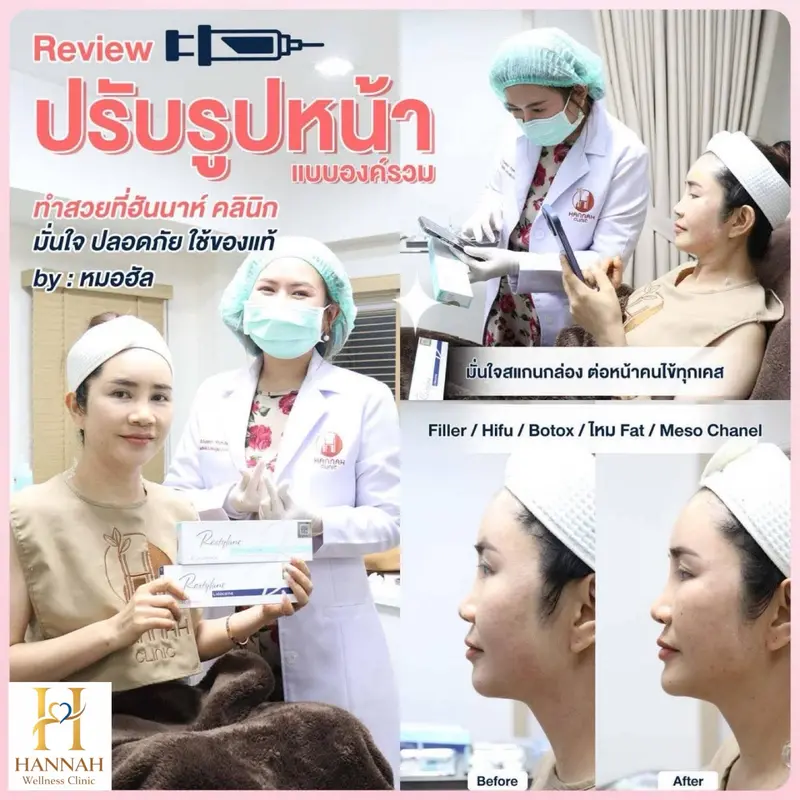 รีวิว Before/After