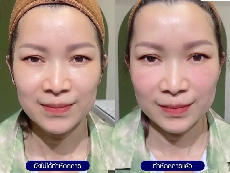 รีวิวหัตถการโปรแกรมไหมน้ำ Ultracol