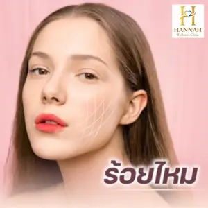 ร้อยไหม ยกกระชับ