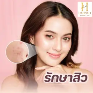 Goodbye Acne และ Miami Peel ขจัดสิว