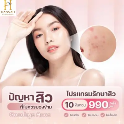 โปรแกรมรักษาสิว 10 ขั้นตอน บอกลาปัญหาสิว รักษาได้ รักษาง่าย ไม่เลี้ยงไข้