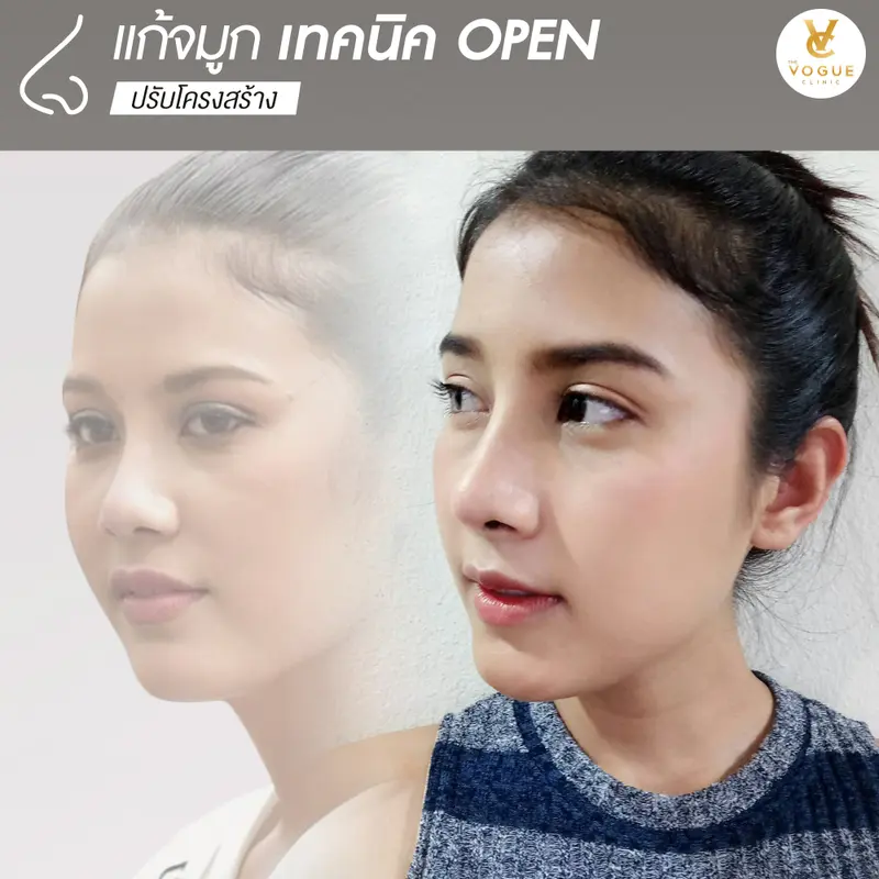 แก้จมูก ชลบุรี